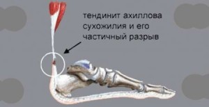 боль между пяткой и носком2