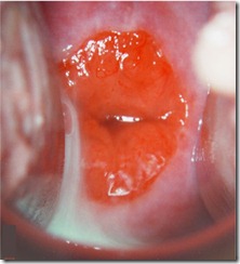 Ectropion