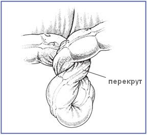 Заворот кишок
