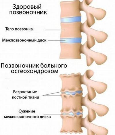 причина боли в шее - остеохондроз