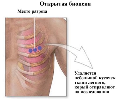 Рак лёгкого 4 степени