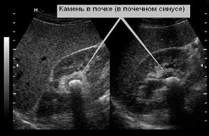 узи почек при беременности