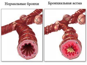 бронхи