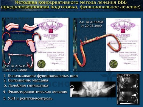 Дисплазия тазобедренных суставов у младенцев