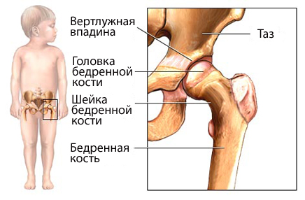 Дисплазия тазобедренных суставов у новорожденных
