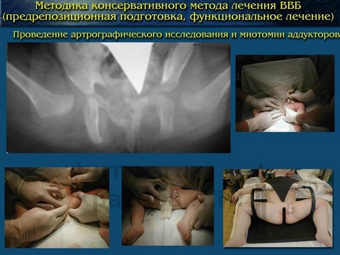 Дисплазия тазобедренных суставов у младенцев