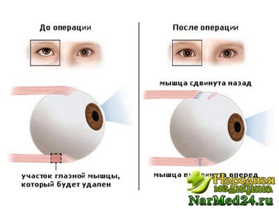 Лечение косоглазия