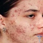 тяжелая угревая сыпь