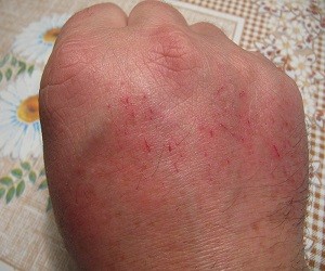 как лечить цыпки на руках