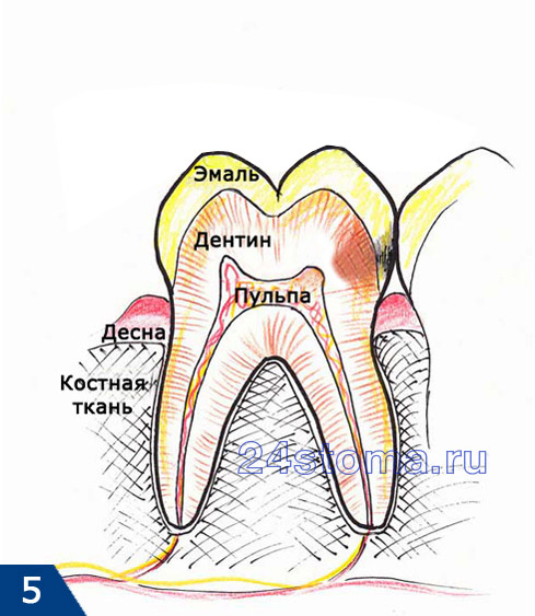Глубокий кариес (исходная ситуация)