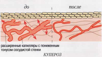Как убрать красные сосудики на лице