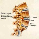 Как-лечить-грыжу-позвоночника