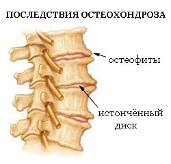 последствия остеохондроза