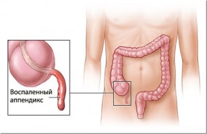 Аппендицит: операция