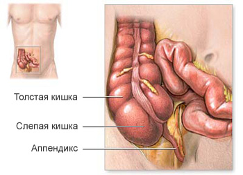 Придаток слепой кишки
