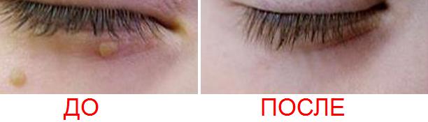 Удаление папиллом