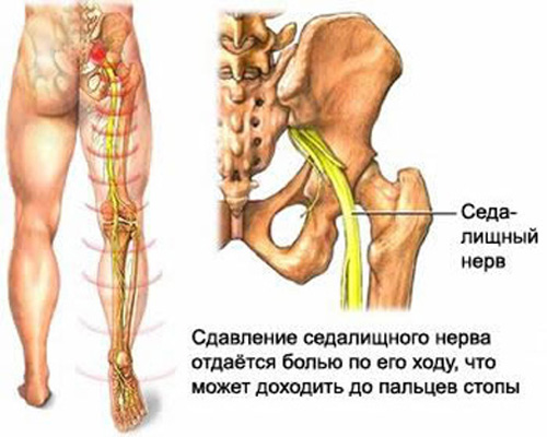 боли в ноге и пояснице