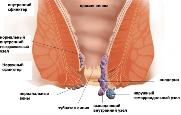 Признаки такого заболевания как геморрой 