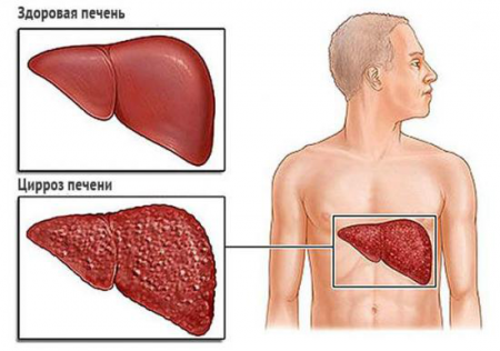 Цирроз печени