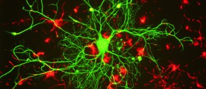 Лечение рассеянного склероза в Германии. Профессиональное лечение болезни рассеянного склероза за границей в Германии, надежда есть!