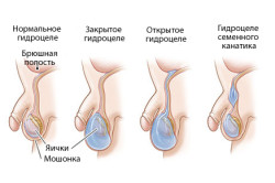 Гидроцеле