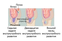 Гидроцеле у новорожденных