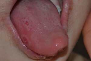 Прыщ на языке у ребенка 2
