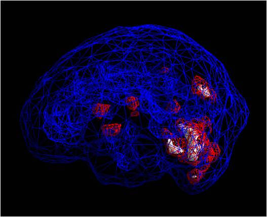 brain-MRT-normal