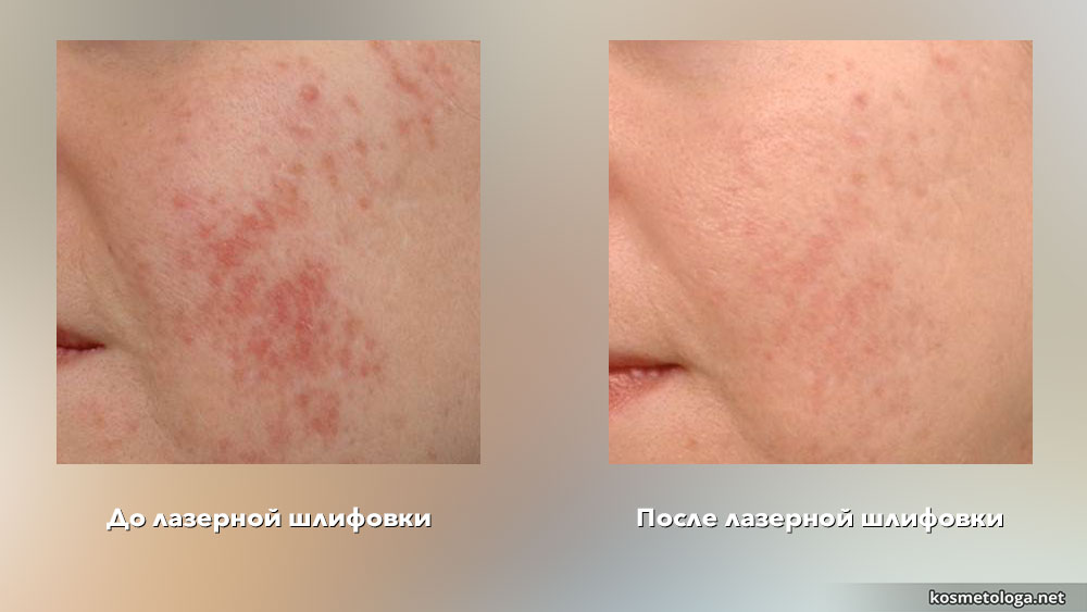 Лазерная шлифовка помогает устранять последствия акне, но не даёт 100% результат.