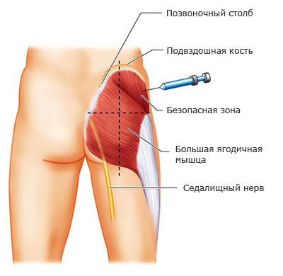 Как правильно делать укол в ягодицу
