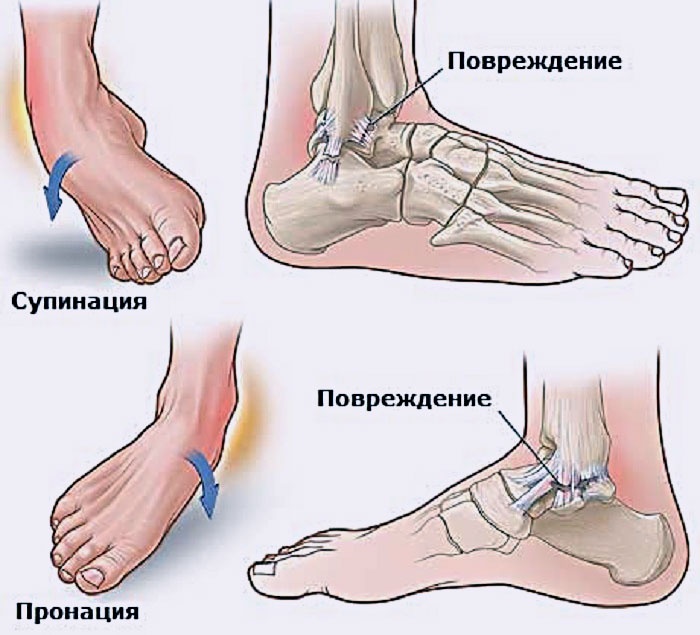 Боли голеностопного сустава