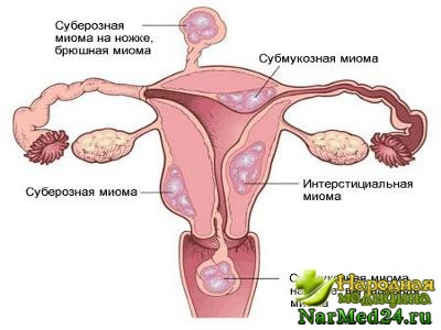 Формы миомы матки