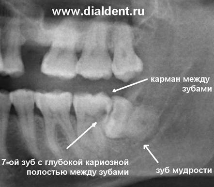 Зуб мудрости