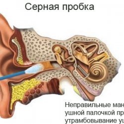 Удаление серной пробки