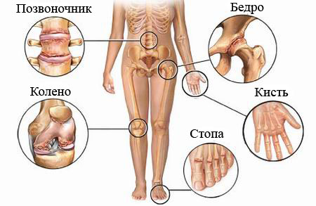 болезни суставов