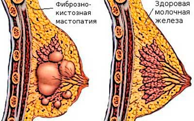 болит грудь