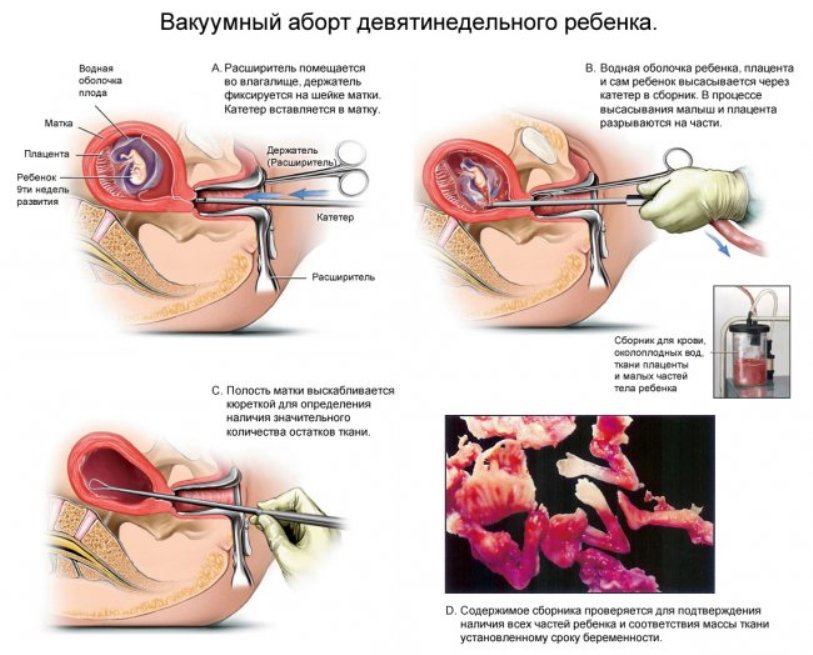 Что такое вакуумный аборт и как он проводится