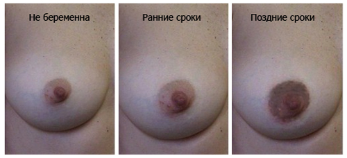 Грудь во время беременности