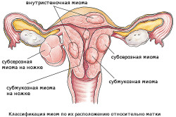 Виды миомы матки