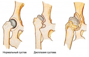 дисплазия тазобедренного сустава лечение у детей